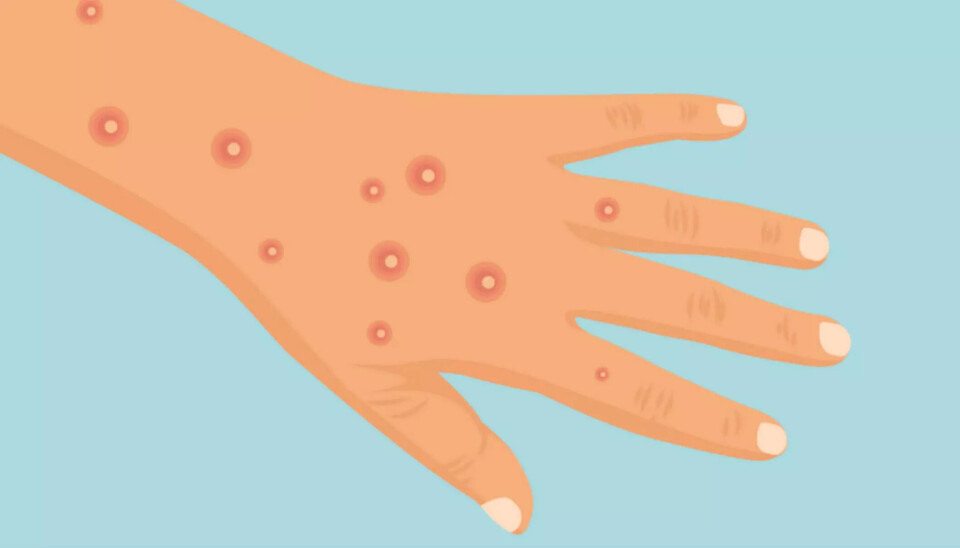 Mpox-utbrudd i Afrika erklært som internasjonal folkehelsekrise