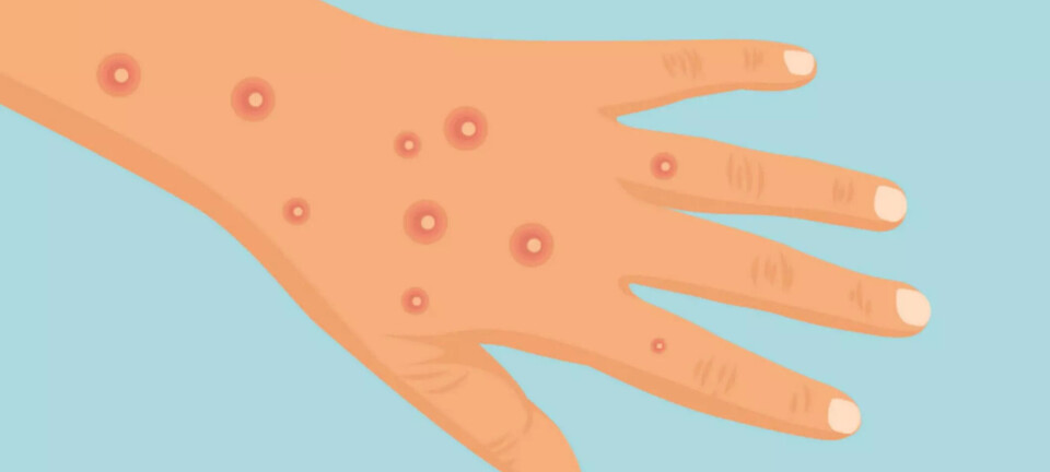 Mpox-utbrudd i Afrika erklært som internasjonal folkehelsekrise
